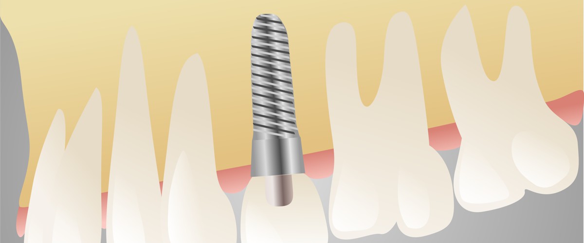 studio dentistico clinica feltre implantologia